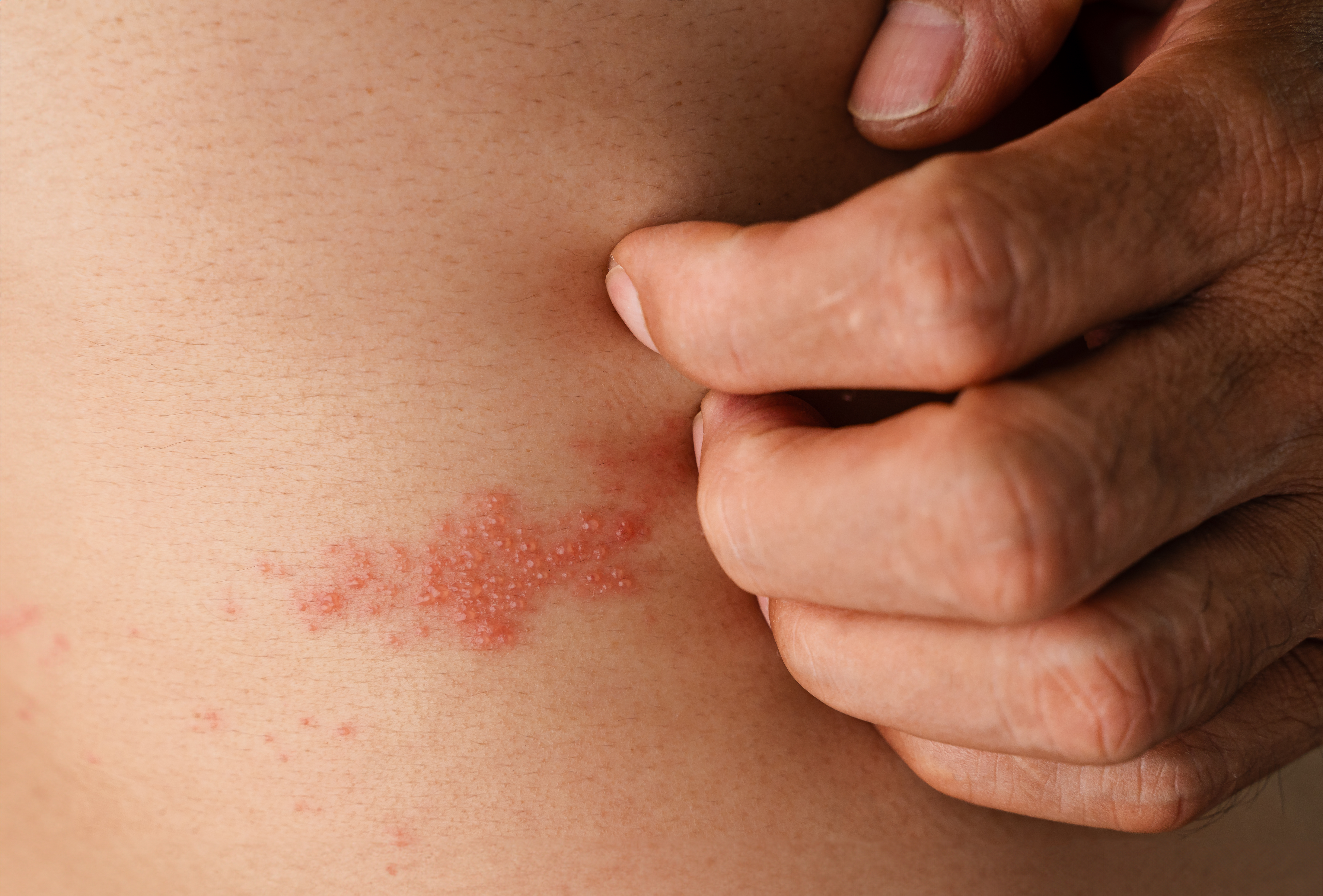 Ayurveda bei Gürtelrose